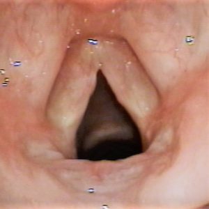 Throat thickening