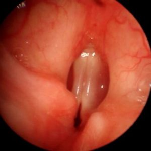 Cordal Paralysis in Adduction