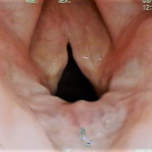 Edema de Reinke