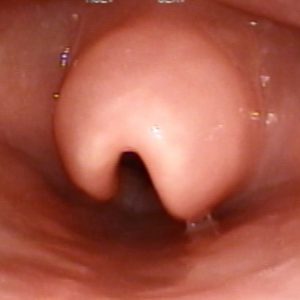Epiglotite