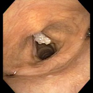 Carcinoma Cordal