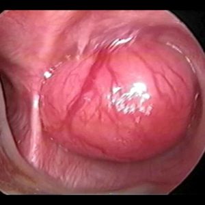 Tumor Brônquico Miofibroblástico
