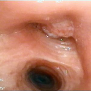Carcinoma Brônquico