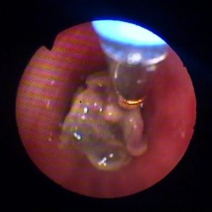Criobiópsia Brônquica