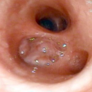 Carcinoma Brônquico