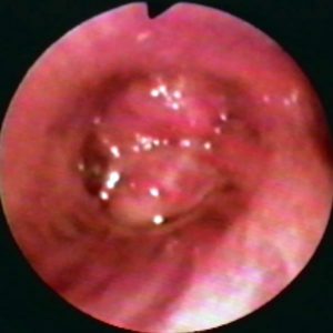 Adenoma Brônquico