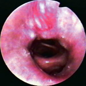 Carcinoma Brônquico