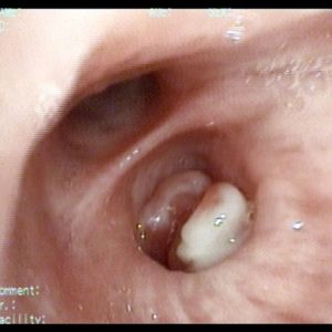 Carcinoma Brônquico