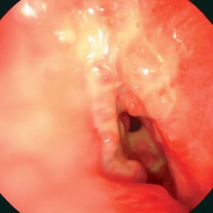 Tumor Brônquico Intramural