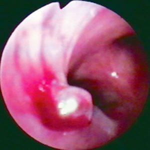 Carcinoma Brônquico
