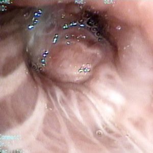 Tumor Brônquico