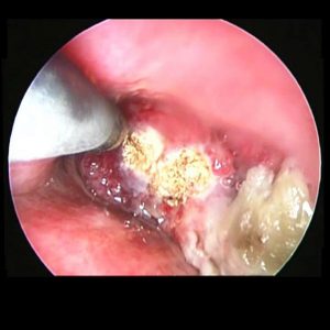 Radiofrequência. Tumor Traqueal