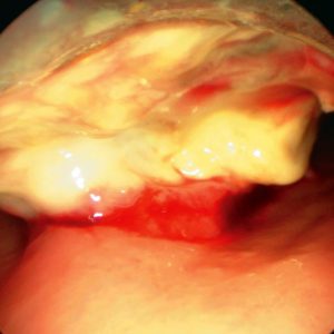 Tumor Traqueal