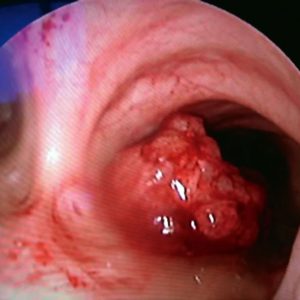 Epidermoid Bronchial Carcinoma