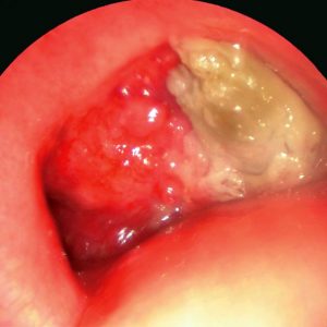 Carcinoma Traqueal
