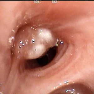 Tumor Brônquico