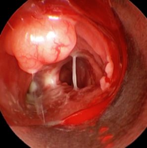 Metástase Traqueal. Carcinoma de Mama