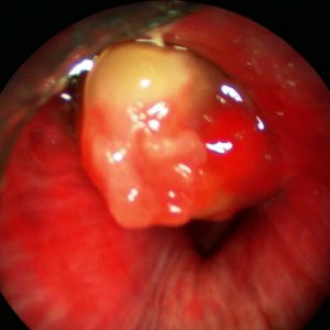 Metástase Brônquica. Carcinoma de Células Claras