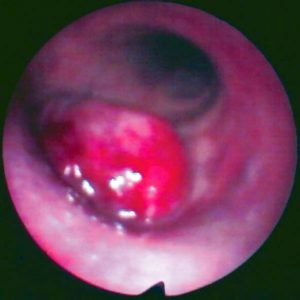 Metástase Brônquica. Carcinoma de Células Claras