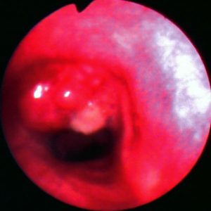 Linfoma Endobrônquico