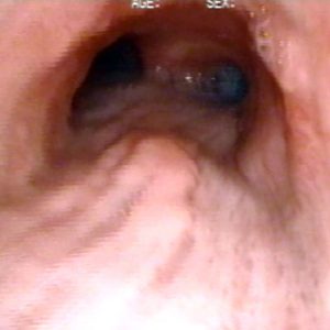 Carcinoma de Esôfago