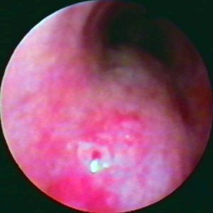 Carcinoma de Esôfago
