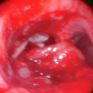 Carcinoma de Esôfago