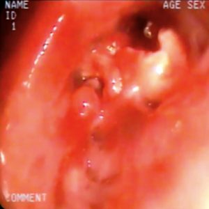 Hamartoma Brônquico
