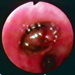 Leiomiossarcoma Brônquico