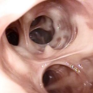 Atrofia da Mucosa Brônquica