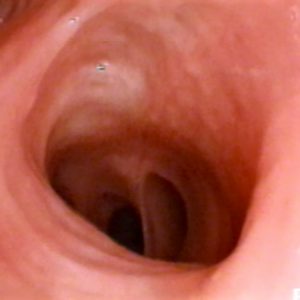 Carcinoma In Situ