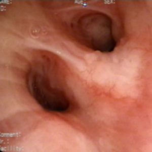 Rugosidade da Mucosa