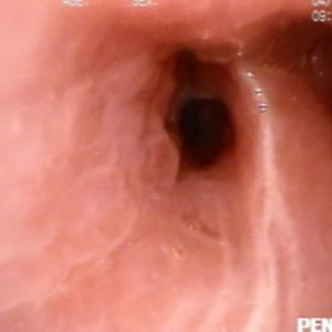 Edema em “Paralelepípedo”