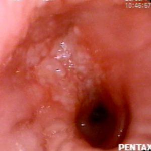 Carcinoma Brônquico