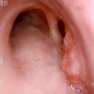 Tumor Endotraqueal