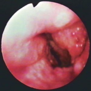 Tuberculose Laríngea