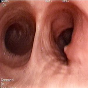 Fístula Ganglio-brônquica