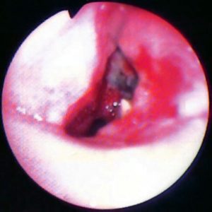 Fístula Ganglio-brônquica