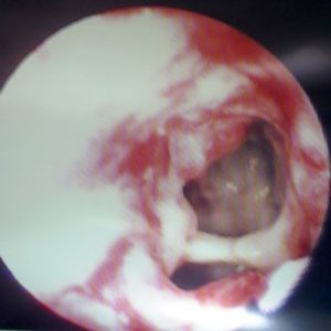 Aspergilose Cavitária