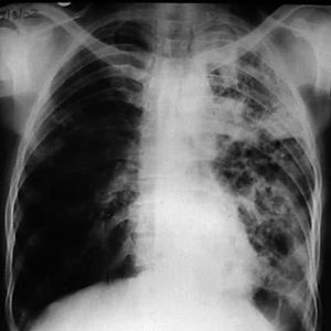 Broncoscopia nas cavidades pulmonares