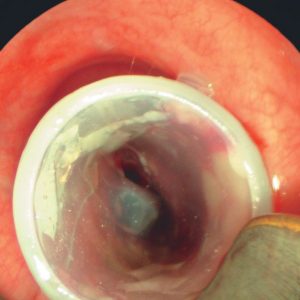 Stent em Estenose Traqueal