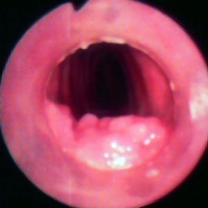 Granuloma por Contato