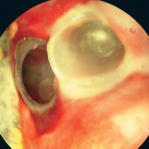 Stent Duplo em Carcinoma