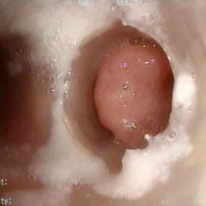Stents e estenoses