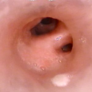 Stent Brônquico