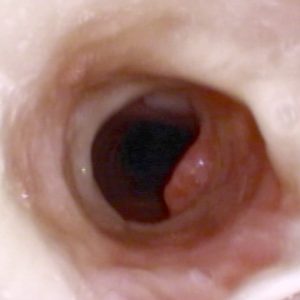 Granuloma Traqueal