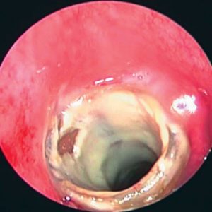 Stent Brônquico. Incrustação de Secreções