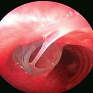 Stent Brônquico. Secreção Filante