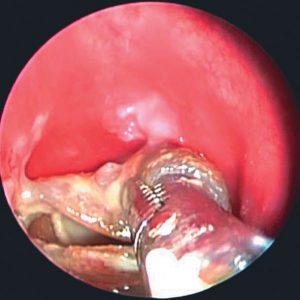 Remoção de Stent