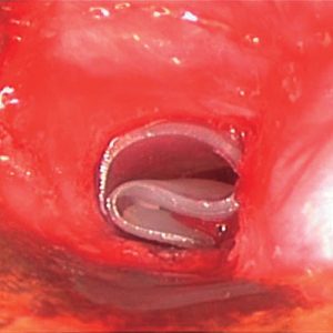 Stent em Ômega